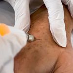 Aurius Plasma - Aparelho Jato de Plasma HTM