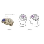 TMS Estimulação Magnética Transcraniana