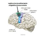 TMS Estimulação Magnética Transcraniana