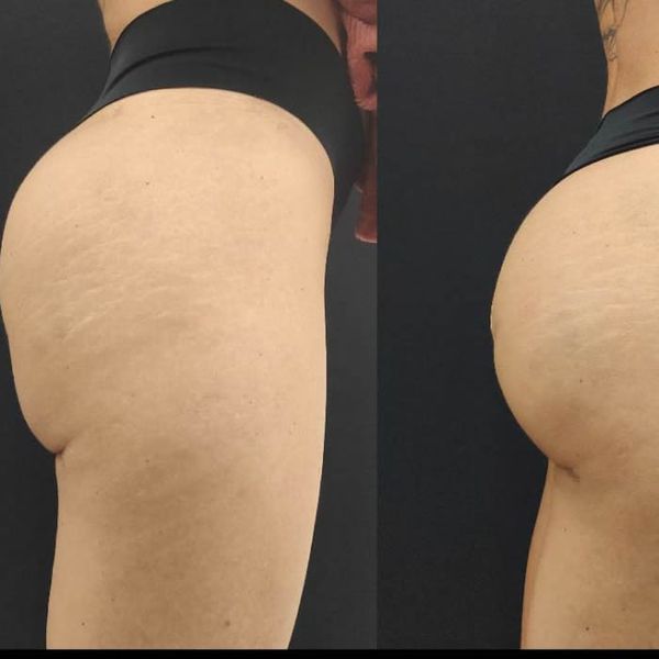  Preenchimento Corporal 70cc | Maxy Fill